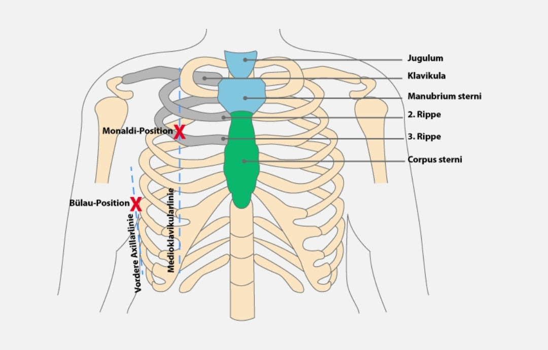 Entlastungspunktionsnadel, needle decompression, Spannungspneumothorax