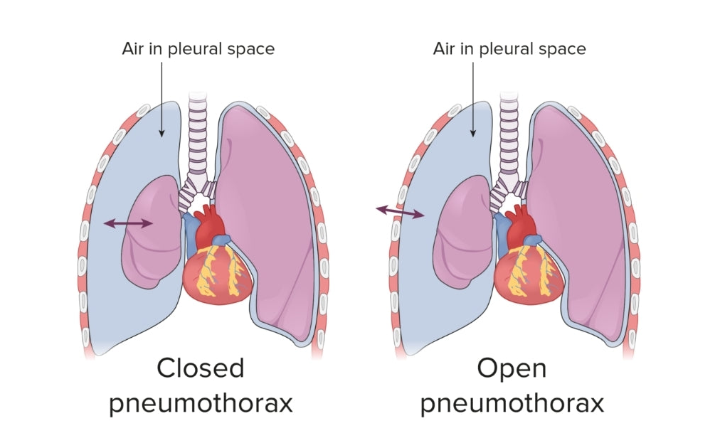 Entlastungspunktionsnadel, needle decompression, Spannungspneumothorax